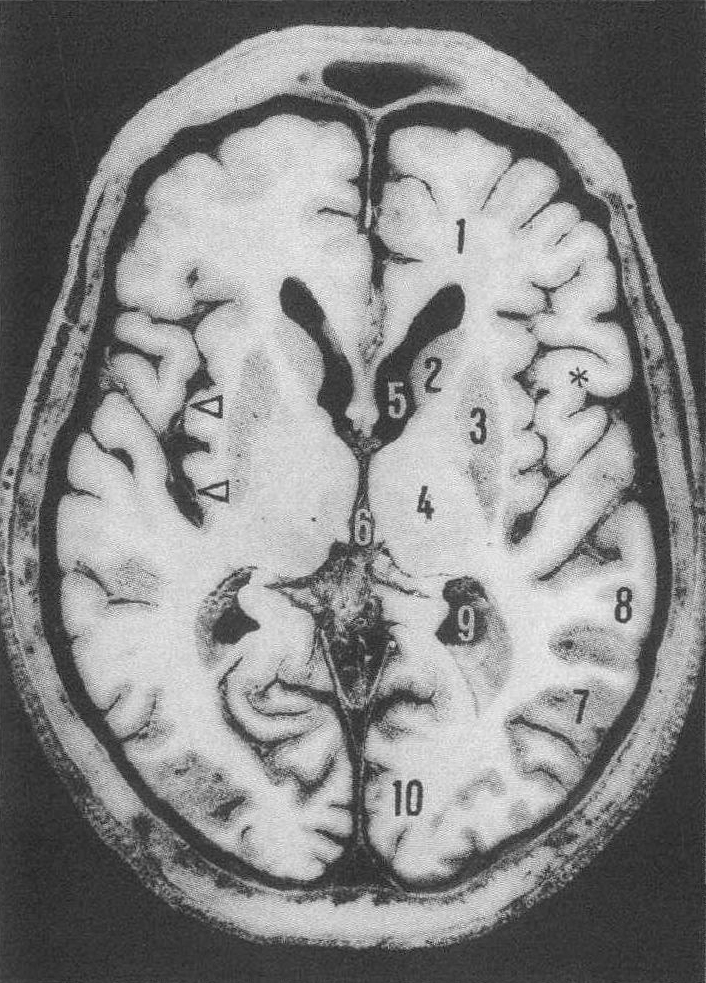 第三脑室上部水平轴位切面人体标本图